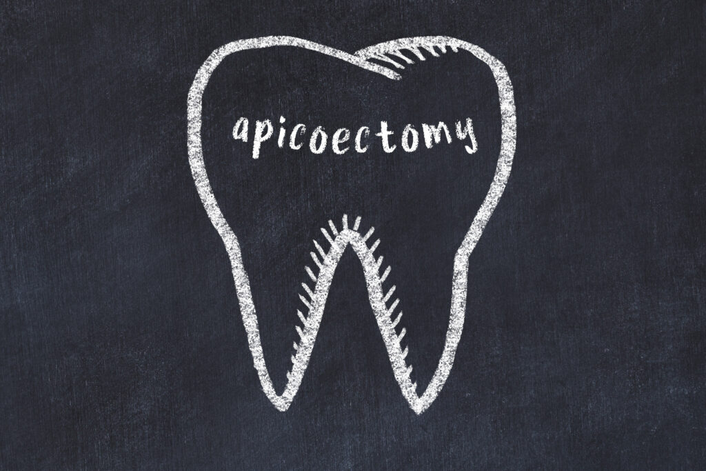 londonderry root canal surgery