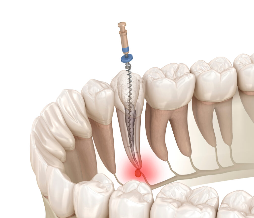 londonderry root canal surgery