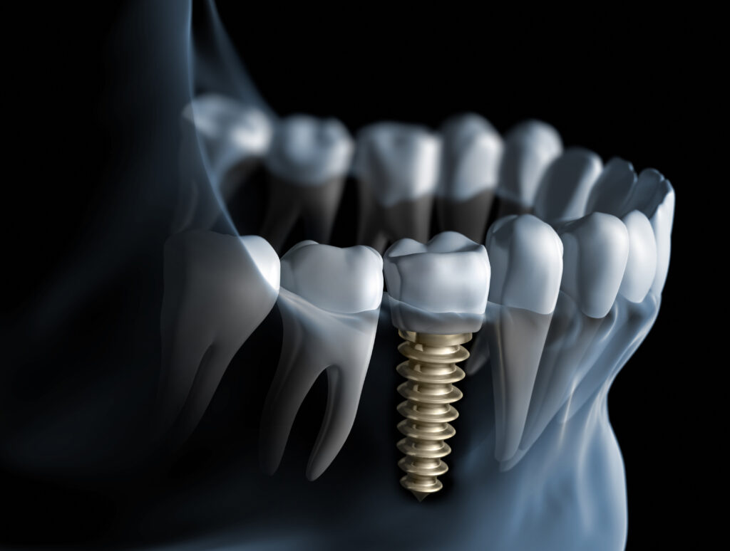 londonderry dental implants