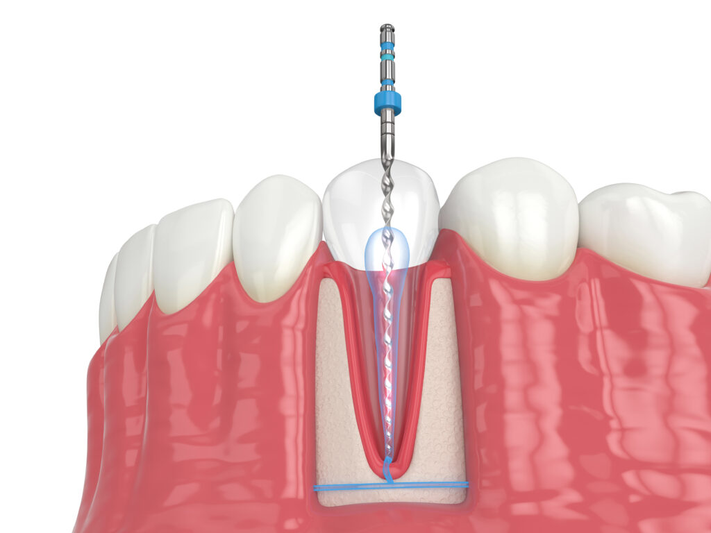 londonderry endodontic surgery