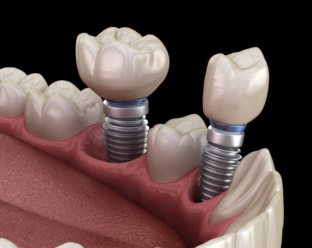 londonderry dental implants