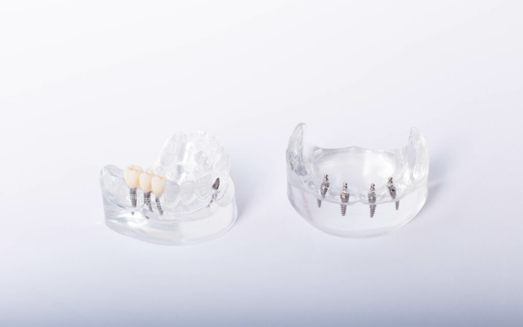 londonderry dental implants